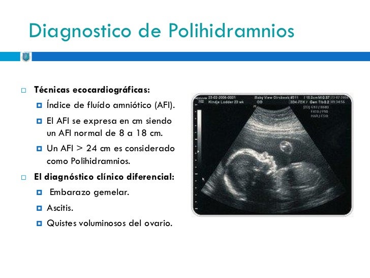 polihidramnios